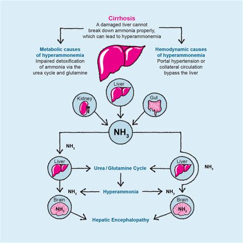 Causes and pathogenesis of hepatic encephalopathy – Hepa-Merz ...