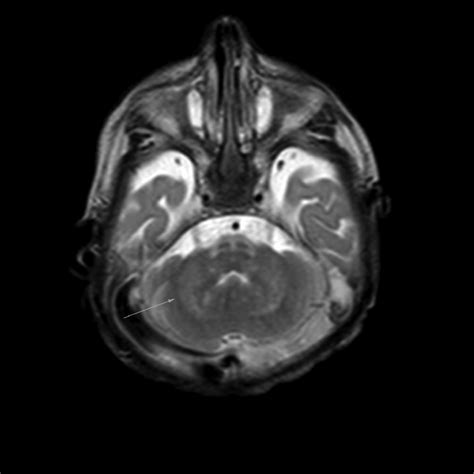 T2-weighted MRI image showing bilateral dentate nucleus hyperintensity ...