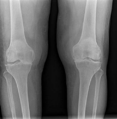 Bilateral knee Xray w/ chronic osteoarthritis pretty much what my latest xrays looked like ...