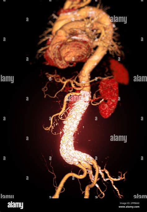 CTA whole aorta with Abdominal aorta stent graft 3D rendering image in case abdominal aortic ...