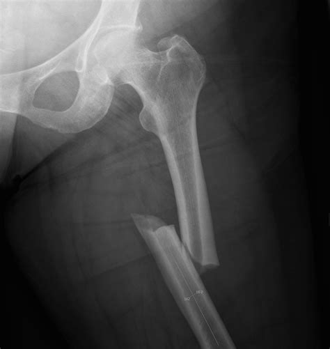 Bilateral Compound Femur Fracture - Foto Kolekcija