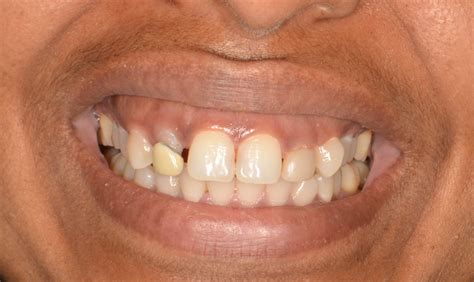 Bonding and Resin Composite – Charlton Dentistry