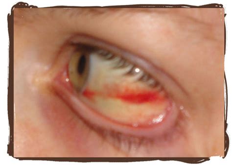 Why Did My Eye Turn Red? Subconjuctival Hemorrhage | HealDove