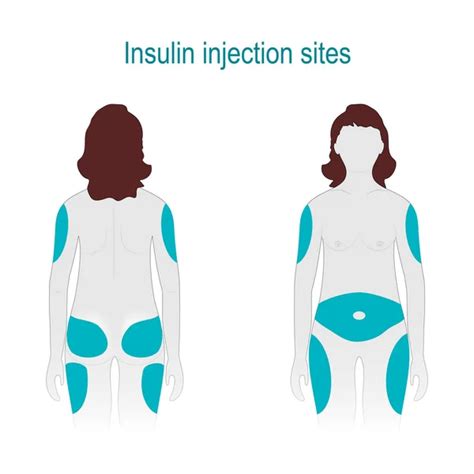 Lugares de inyección de insulina vector, gráfico vectorial © Pikovit ...