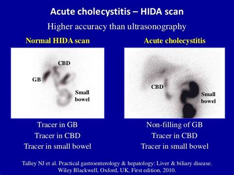 Ultrasound of acute & chronic cholecystitis