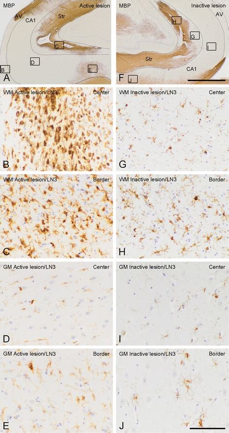 Histopathological features of active and inactive hippocampal MS... | Download Scientific Diagram