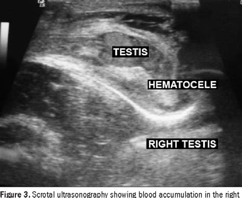 Figure 2 from Scrotal hematoma as a sign of adrenal hemorrhage in newborns | Semantic Scholar