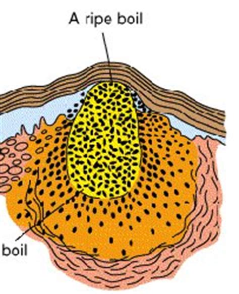 Boils (Furuncle) – Pictures, Causes, Prevention, Treatment and Natural ...