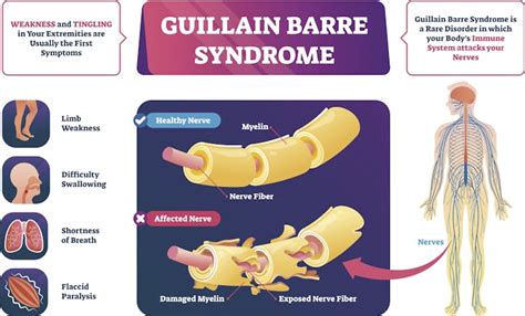 Rare neurological disorder, Guillain-Barre Syndrome, linked to COVID-19