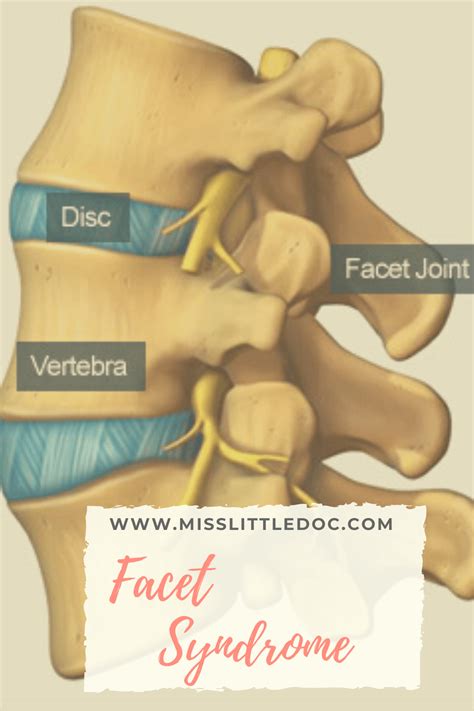 Facet Syndrome ⋆ Physical Health, Physical Therapy, Health And Wellness ...