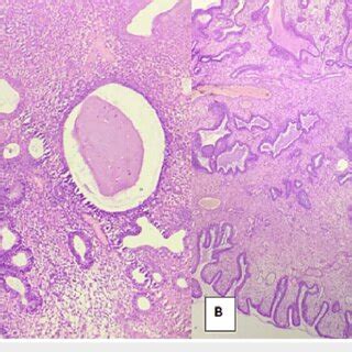 Disordered proliferative endometrium and endometrial polyp A ...