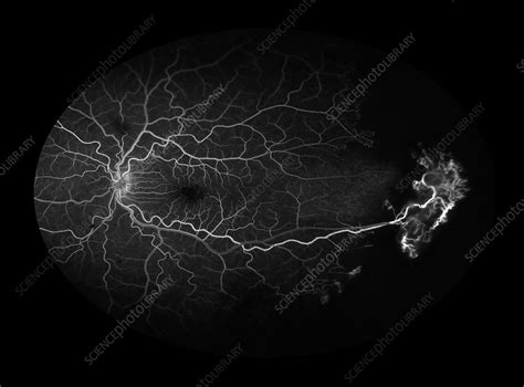 Sickle Cell Retinopathy - Stock Image - C027/2251 - Science Photo Library