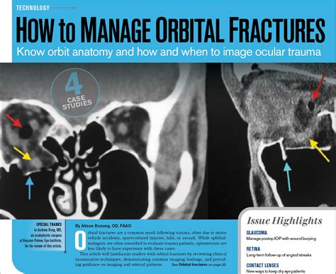 Fracture Orbital Floor Icd 10 | Viewfloor.co