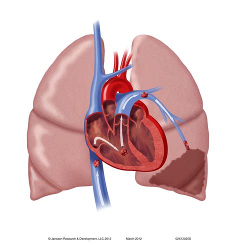 Pulmonary Embolism