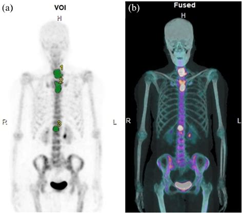 Spect Bone Scan