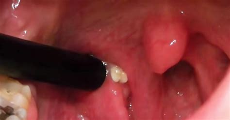 Tonsil Stones Symptoms and 10 Home Natural Treatments - DavidWolfe.com