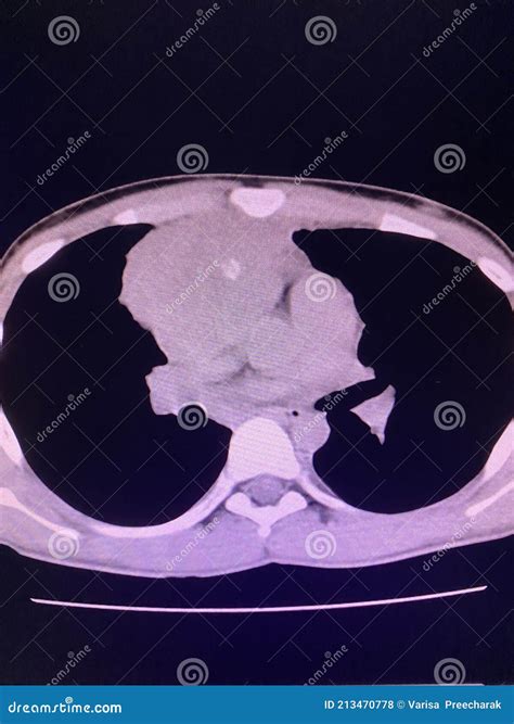 CT Scan Mass at Interior Mediastinum Stock Photo - Image of chronic ...