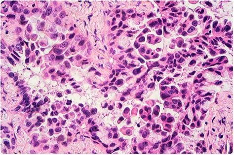 What are the Differences Between Small Cell and Non-Small Cell Lung Cancer? - UWINHEALTH