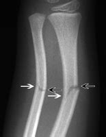 Greenstick Fracture - Definition, Causes and Treatment