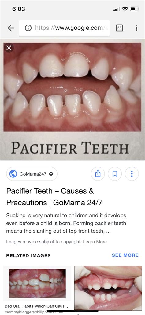 Pacifier Use And Teeth