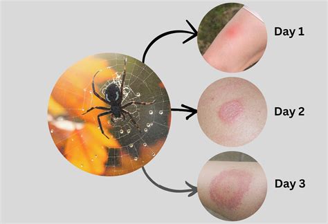 Southern Black Widow Spider Bite: Stages, Symptoms with Pictures ...