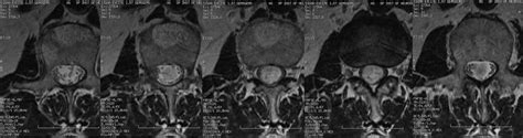 Dr Balaji Anvekar FRCR: Intraspinal mass, a nerve sheath tumor on MRI; Importance of MR Myelography