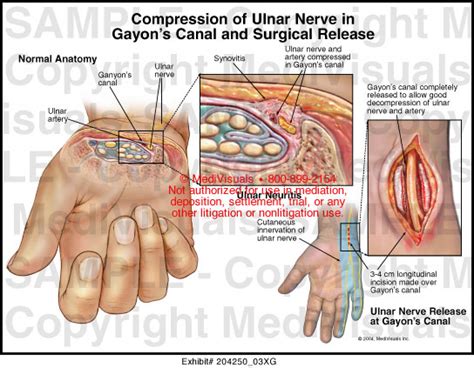 Compression of Ulnar Nerve in Gayon's Canal & Surgical Release