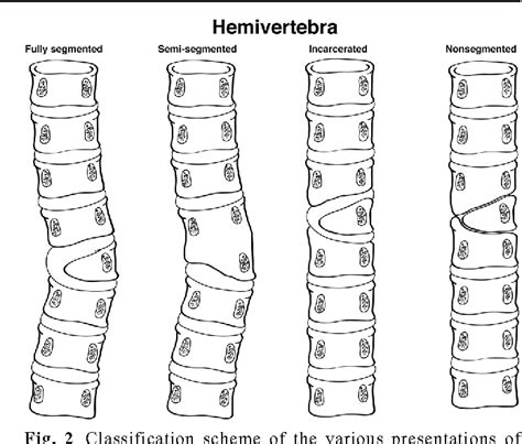 Hemivertebrae: a comprehensive review of embryology, imaging ...