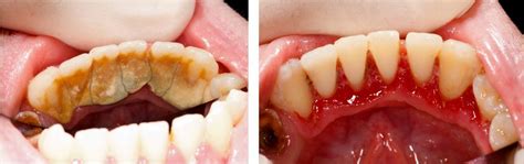 Gingivitis Before And After Treatment