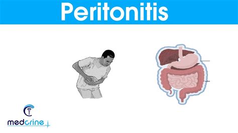 Peritonitis : causes, signs and symptoms and treatment - YouTube