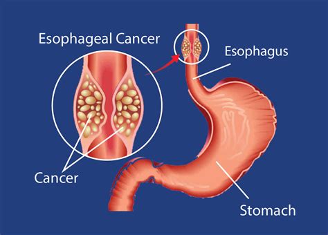 #1 Esophageal Cancer Treatment in Delhi - Dr. Priya Tiwari