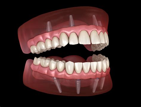 All-on-4 Dental Implants - Memphis, TN - Southern Dental Implant Center