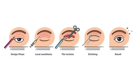 Double Eyelid Surgery in Singapore - Allure Plastic Surgery