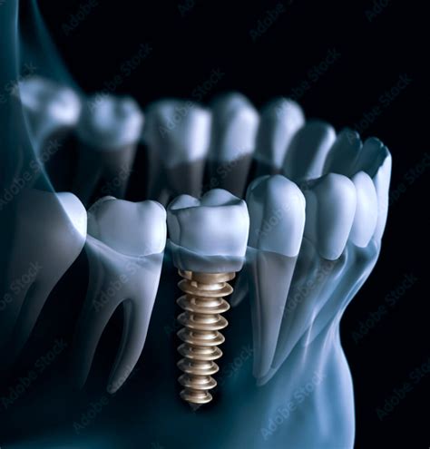 Implant Surgery 2022 - Advanced Dentistry Institute