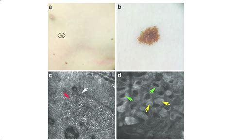 Spitz nevus localized on the trunk (a). Dermoscopy showed a globular... | Download Scientific ...