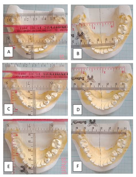 Differences in dental arch characteristics... | F1000Research