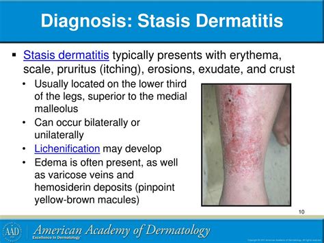 Causes Of Stasis Dermatitis