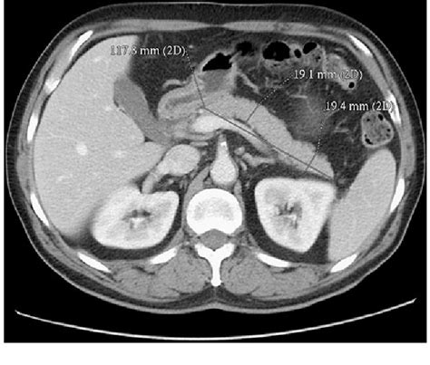 Figure From Ct Volumetry Of Normal Pancreas Correlation | My XXX Hot Girl