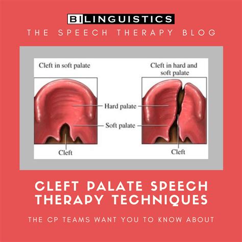 Cleft Palate Speech Therapy Techniques: CLP Team Tips | Cleft palate speech therapy, Cleft ...