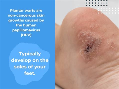 Are Plantar Warts Contagious – Associated Dermatologists