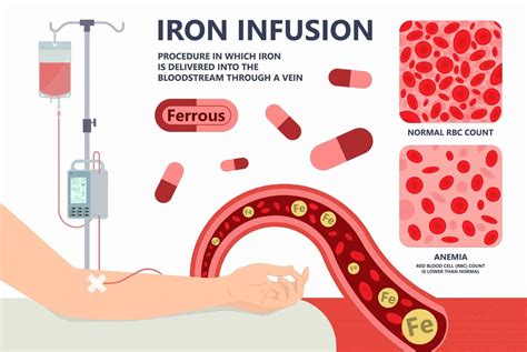 Iron Booster IV Infusion - Wellness IV Infusion Therapy