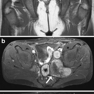 Malignant peripheral nerve sheath tumor (MPNST). MRI in a 14-year-old... | Download Scientific ...