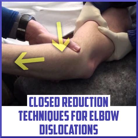 Closed Reduction Techniques for Elbow Dislocations - Sports Medicine Review