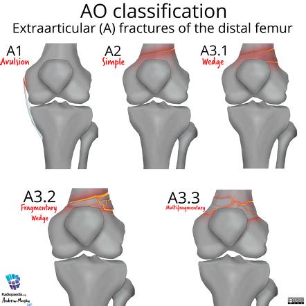 Ao Classification Of Distal Femur Fractures Radiology Reference | My ...