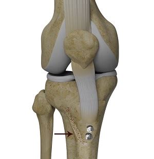 Tibial Tubercle Transfer Houston, TX | Patellar Instability Cypress, TX | Osteoarthritis Tomball, TX