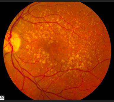 Macular Degeneration: Is There a Cure and How Can It Be Treated