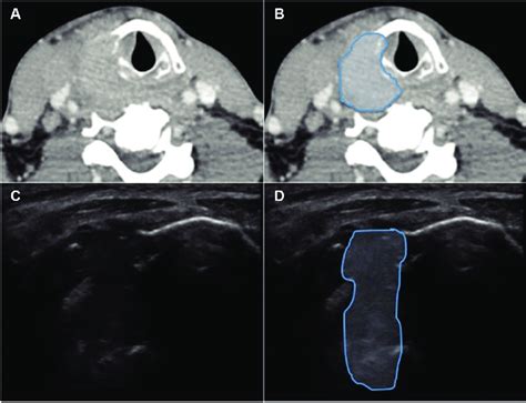 Hypopharynx-larynx, patient 16. (A) Axial computed tomography (CT). (B)... | Download Scientific ...