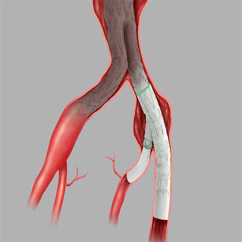 Zenith® Branch Endovascular Graft- Iliac Bifurcation - Endovascular ...