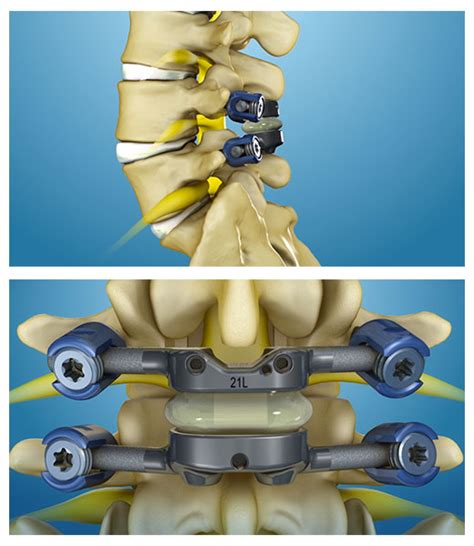 Facet Joint Replacement - ONZ Spine