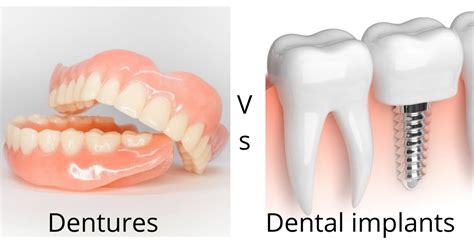 Dentures vs Implants – Pros and Cons – Indodentist – Dr. Akriti Dogra